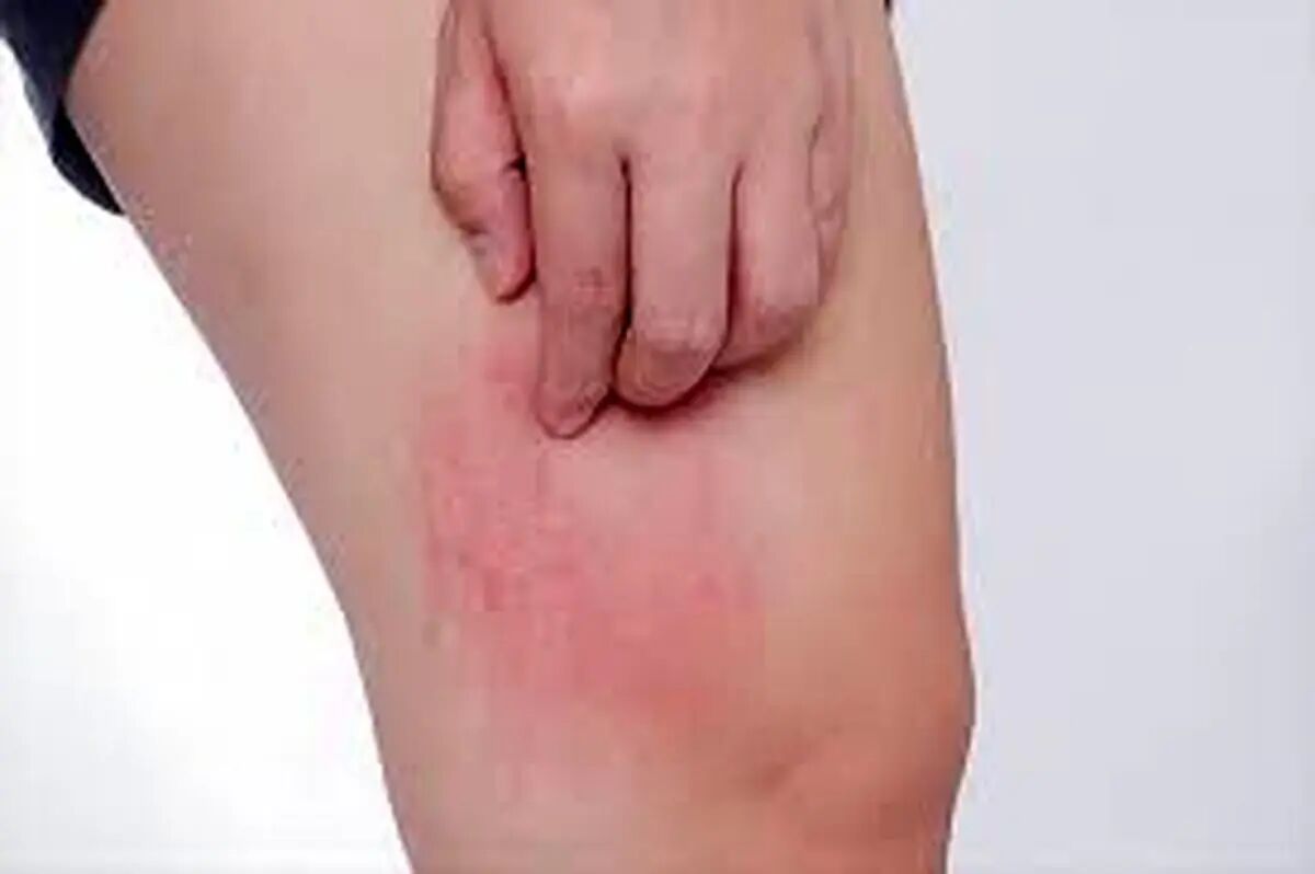کهیر پوستی چیست و چگونه درمان میشود ؟