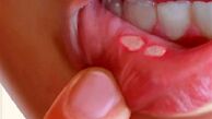 چگونه "آفْت دهان" خود را با چند راهکار طب سنتی درمان کنیم؟