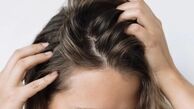 چگونه از چرب شدن پوست سر جلوگیری کنیم؟