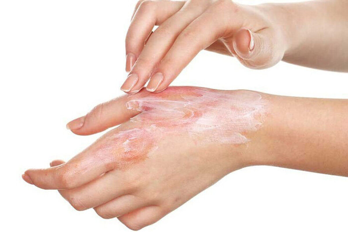 علت سوزش بی دلیل پوست پا و دست ها چیست؟