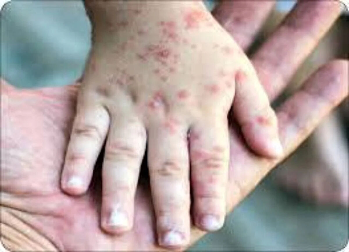 هشدار درباره موج تازه آبله‌مرغان در بهار+ علائم، دوره سرایت و نکات حیاتی مراقبت
